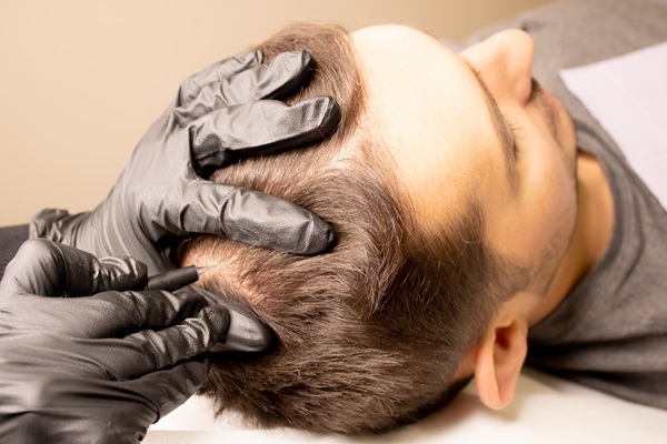 Approaches To Hair Restoration For Men