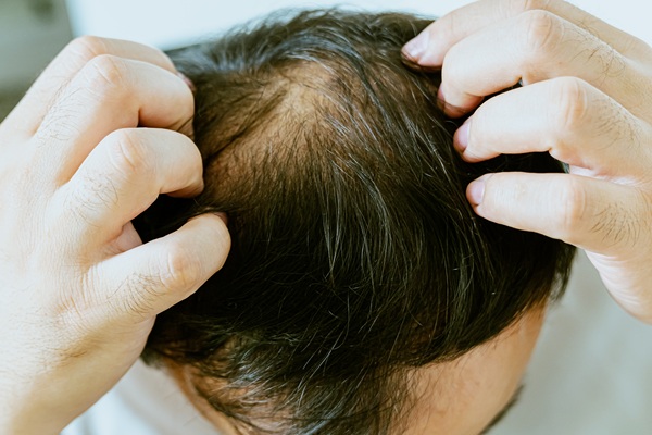 What To Expect From A Hair Restoration Consultation For Men