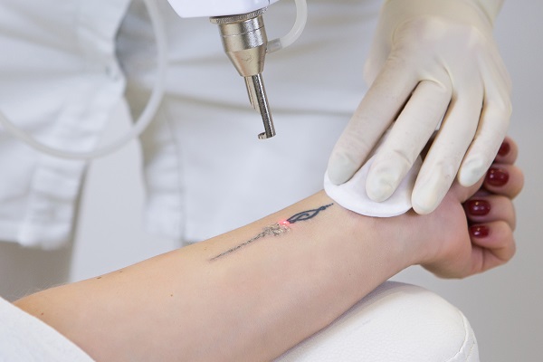 Understanding The Process Of Laser Tattoo Removal