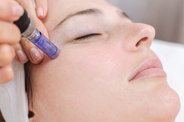 Improve The Texture Of Your Skin With Microneedling