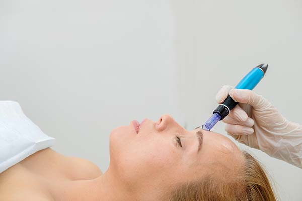 Microneedling Treatment For Healthier Skin