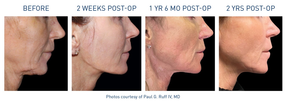 Renuvion - Before & After
