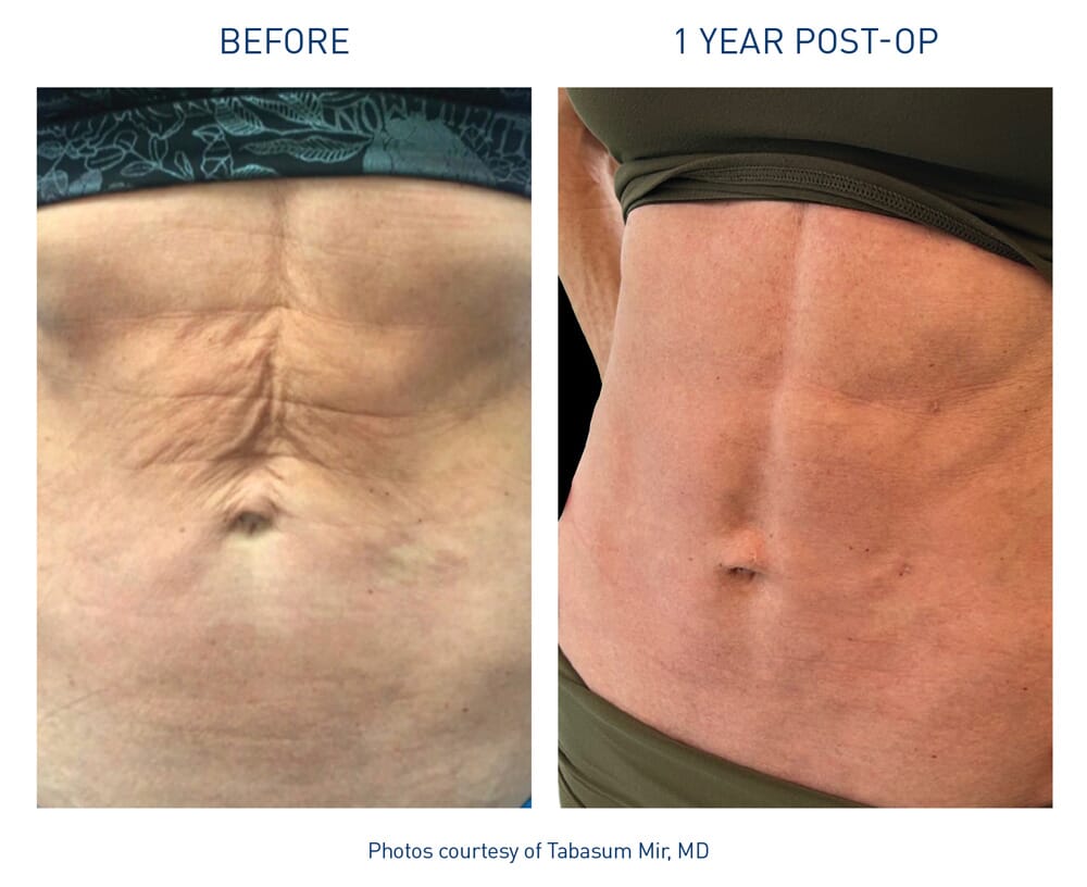 Renuvion - Before & After