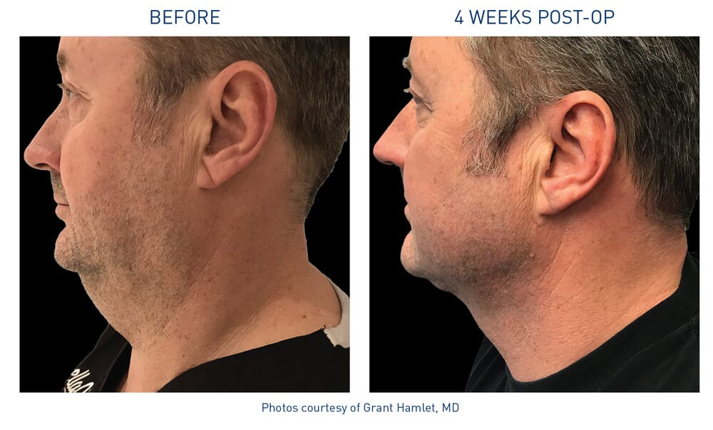 Renuvion - Before & After